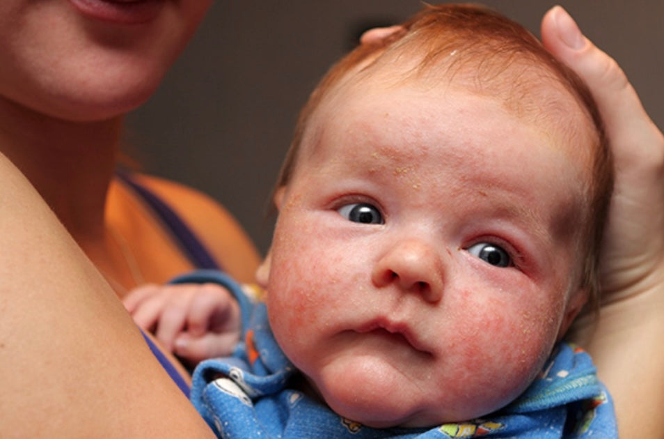 How to Reduce Eczema Triggers in Babies (Gentle Tips for Sensitive Skin)
