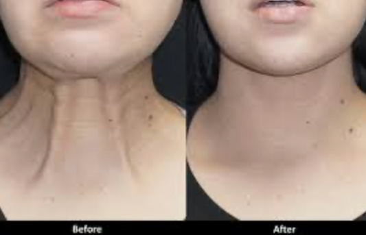 Want To Get Rid of Neck Bands? Botox Can Help!
