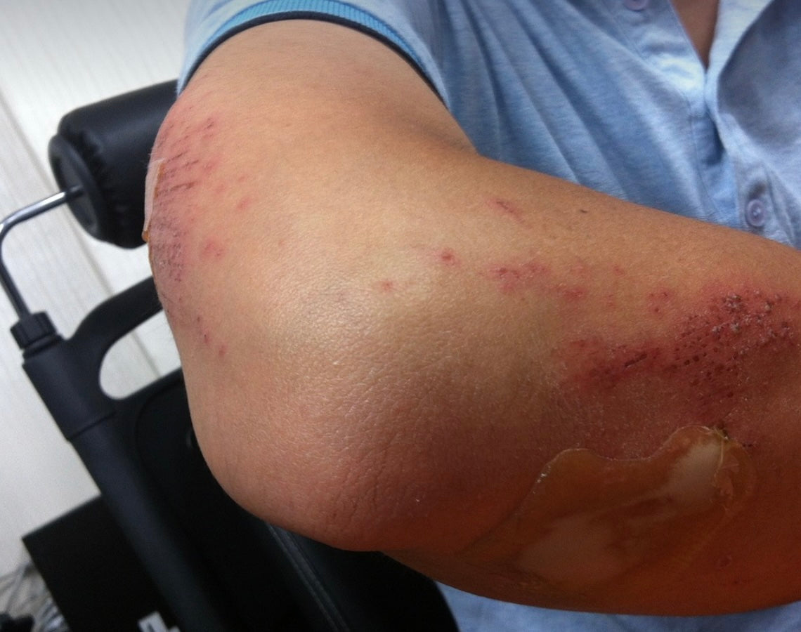 Airbag Rash How to Treat Airbag Burns: Immediate Steps and Long-Term Care – Finn + Emma
